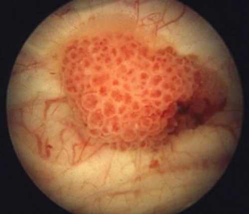 oberflächliches, polypöses (etwas, das aussieht wie ein Polyp) Urothelkarzinom (Tumor im oberen Harntrakt)