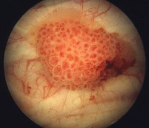 oberflächliches, polypöses (etwas, das aussieht wie ein Polyp) Urothelkarzinom (Tumor im oberen Harntrakt) 